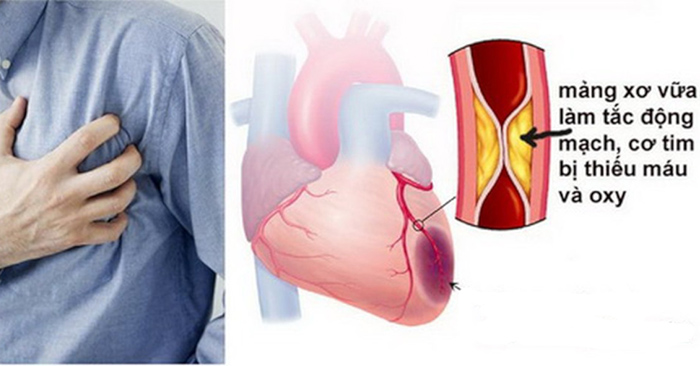 Xơ vữa động mạch gây nhồi máu cơ tim