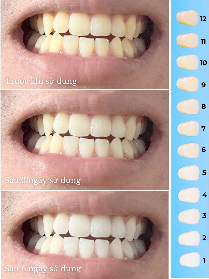Trải nghiệm liệu trình 7 ngày với miếng dán trắng răng Halio Teeth Whitening Strips