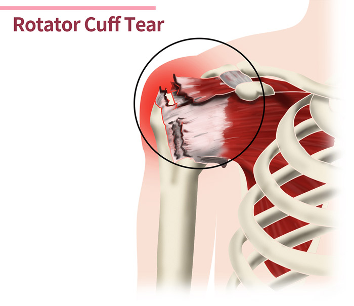 Rách chóp xoay có thể xảy ra do các chấn thương đột ngột, viêm gân hoặc thoái hóa