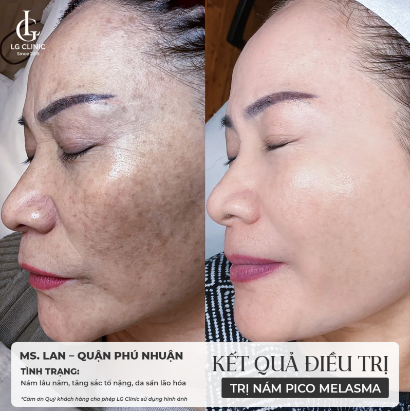 Khách hàng chia sẻ sự hài lòng và kết quả sau liệu trình điều trị nám tại Phòng khám Da liễu LG